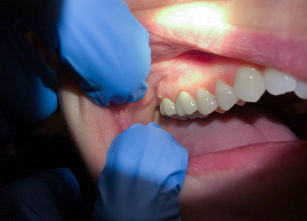 Best Emergency Tooth Extraction in Mount Hope, WV